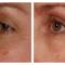 Eyes by thermage