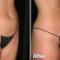 SmartLipo