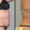 SmartLipo