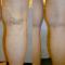 Varicose veins treatment