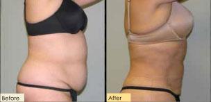 smartLipo