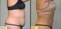 Cool Lipo/SmartLipo