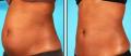 Laser Lipolysis
