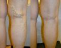 Endovenous Laser ablation for varicose veins
