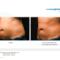 Before and after Coolsculpting