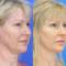 Before and after Facelift