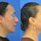 Pre and Post Rhinoplasty