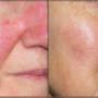 Rosacea Treatments