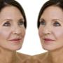 Skin Needling Before and After