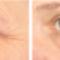 CACI-Eyelift