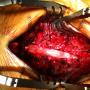 Cervical cord thorough decompression