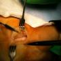 median nerve thorough decompression.