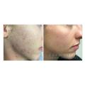 Acne and Acne Scar removal