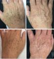Melasma & Pigmentation