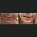 Ultherapy skin tightening and skin lifting treatment