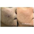 Vibro Microdermabrasion