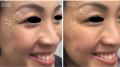Non surgical eye bags & wrinkle