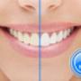 In-Chair teeth whitening - a quick and easy option