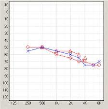 Typical-Presbyacusis-Loss