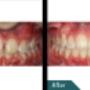 Before and After