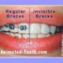 Regular vs. Invisalign braces