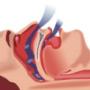 Sleep Apnea treatments
