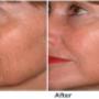Anti wrinkle injections Brisbane