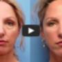 Laser Skin resurfacing Brisbane