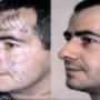 Laser Tattoo removal Brisbane