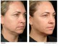 Non-surgical face lift