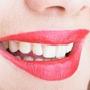 Teeth Whitening Cambelltown