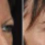 eyelid surgery