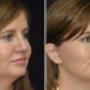 face surgery