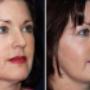 facelift