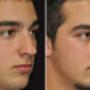 rhinoplasty