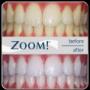 Sydney Teeth Whitening