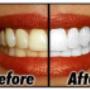 Teeth Whitening Sydney