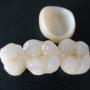 Crowns And Bridges Dentist North Lakes Kallangur