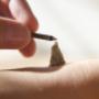 Moxibustion