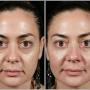 hollows-before-and-after.jpg
