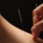 Dry-Needling Treatment