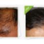 Before and After FUEHair Transplant
