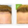 Before and After FUT Hair Transplant