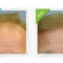 Before and After FUT Hair Transplant