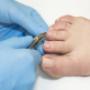 heel treatment