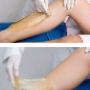 Sugaring Hair Removal
