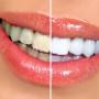 Teeth Whitening