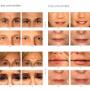 Dermal Fillers - Lines & Wrinkles