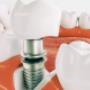 dental implant recovery - dr paulo pinho oral surgery clinic - sydney