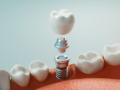 Dental Implants – How Long Does It Last